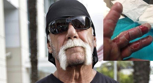 Hogan asks Kane for burn remedies